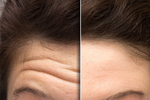 A woman before and after PRF in Bayside