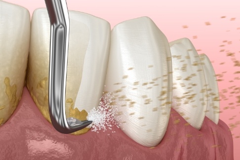 Illustrated dental instrument removing plaque from teeth