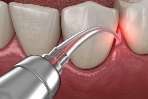 Illustrated dental laser treating gum disease