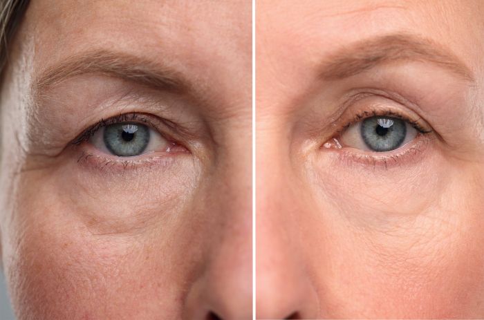 A woman before and after PRF undereye treatment